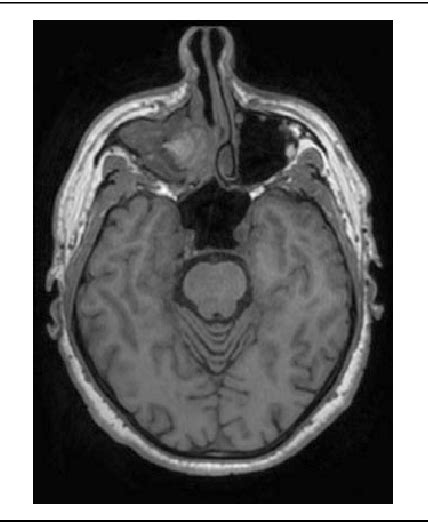 Figure 1 From Cluster Like Headache Secondary To Maxillary Sinusitis By