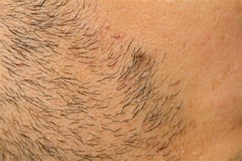 How To Remove Ingrown Hair Effective