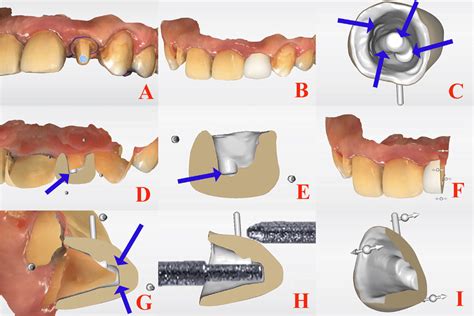 Digital Workflow Of The Cad Cam Crown A Digital Impression Of The