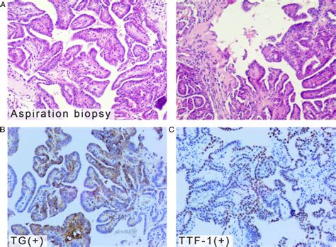 Papillary Thyroid Carcinoma With Breast And Bone Metastasis Dan Zhang