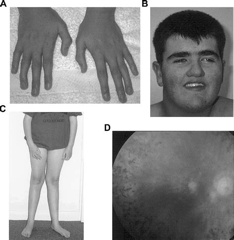 Figure 1 From Delineation Of Cohen Syndrome Following A Large Scale