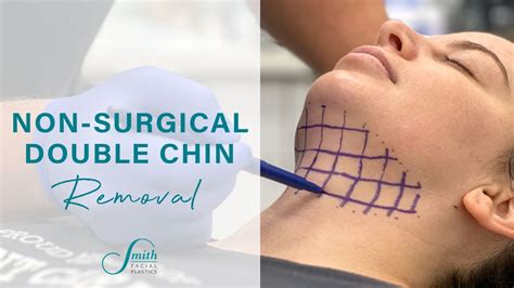 Non Surgical Double Chin Removal Smith Facial Plastics Youtube