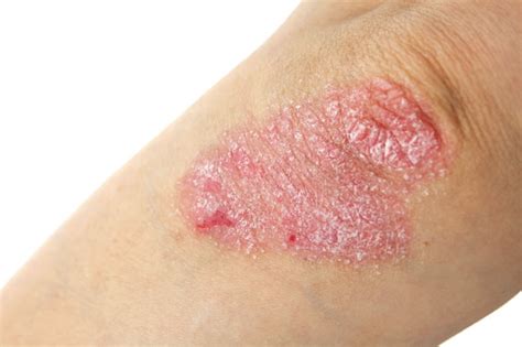 Schuppenflechte (Psoriasis) - Behandlung und Therapie - eMEDI.de