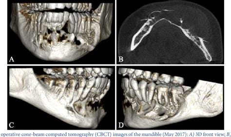 Figure 2 From Odontogenic Keratocyst A Case Report Emphasizing On Root