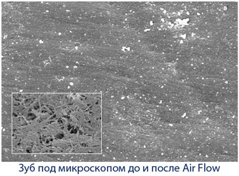 Гигиеническая чистка зубов Air Flow: что это такое? | Круглосуточная ...