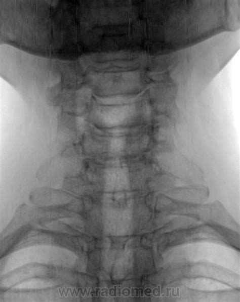 Направлена на рентгенографию шейного отдела позвоночника | Портал ...