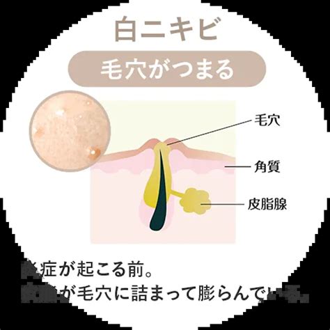 できてしまったニキビを早く治すには？悪化するng行動も【美容皮膚科医監修】 【東京4院・大阪3院】美容皮膚科フェミークリニック