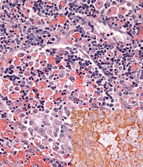 Histiocytic Sarcoma Complex Distinctive Syndromes Histiocytosis