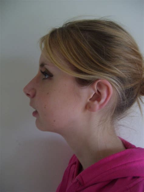 jaw surgery story day