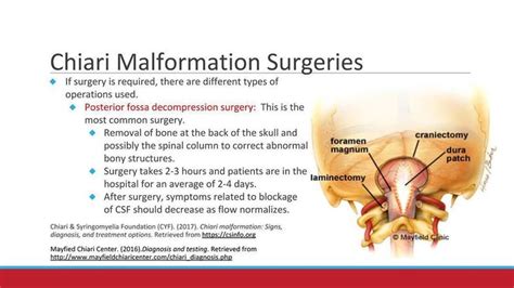 Chiari Malformation (#CM) – Chiari Malformation Surgeries If surgery is required, there are ...