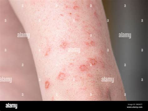 Rash On Hands Syphilis