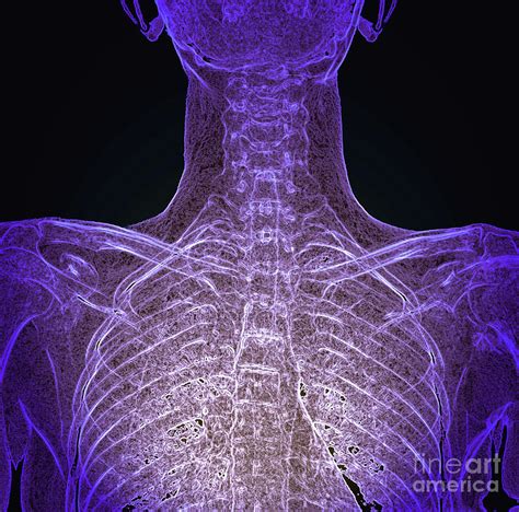 Healthy Rib Cage Photograph By Zephyr Science Photo Library Pixels