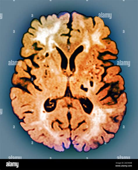 CADASIL syndrome. Coloured axial magnetic resonance imaging (MRI) scan ...