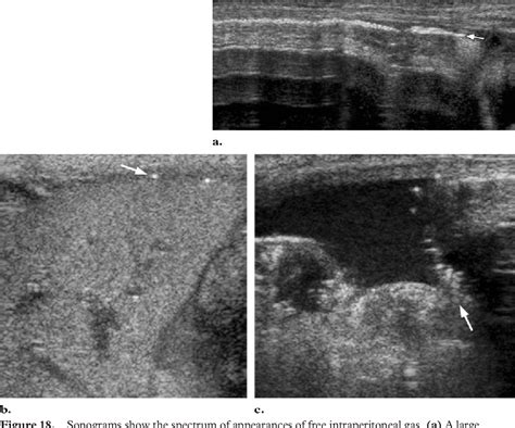 Figure 1 From Necrotizing Enteroco Litis Review Of State Of The Art