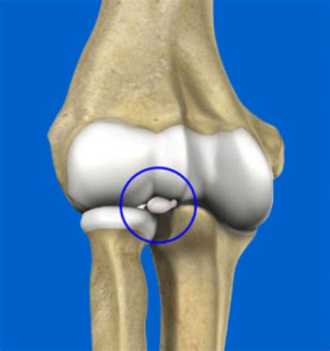 Loose Bodies in Knee - Carolinas Pain Center - Causing your knee pain?