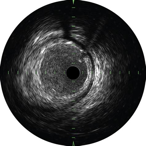clarispro hd ivus extended bandwidth catheter infraredx infraredx