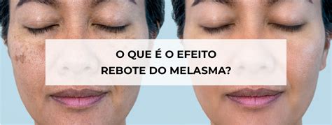 Melasma Produtos Que Ajudam A Clarear Manchas Blog Ada Tina