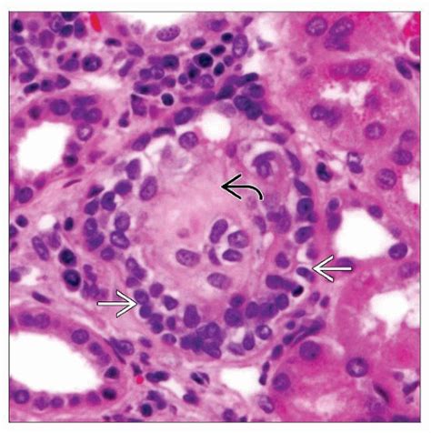 Diffuse Mesangial Sclerosis Basicmedical Key