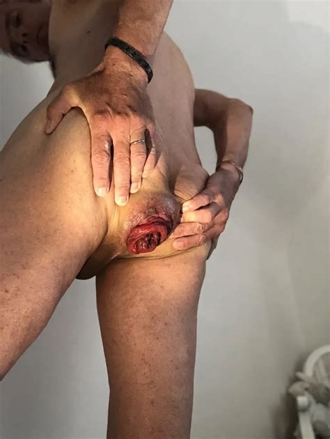 Dilatation Prolapse Anal Pics Xhamster