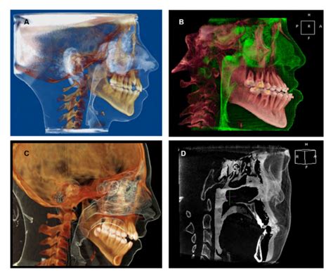 Volume Rendered Cbct Images For The Airway In Either Color Enhanced