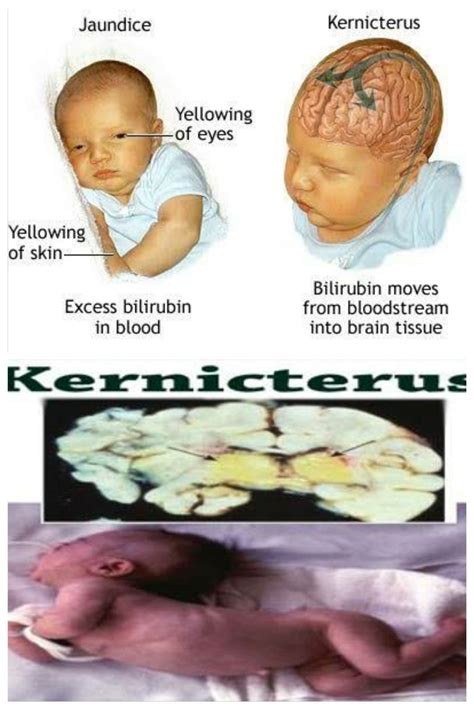 Kernicterusbilirubin Encephalopathy Medizzy