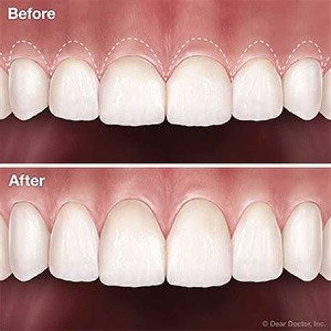 Before And After Gum Surgery