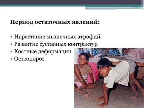 Полиомиелит - online presentation