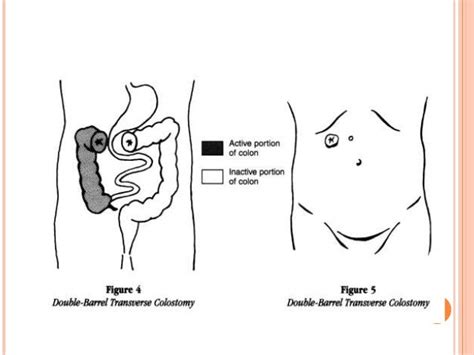 Stoma