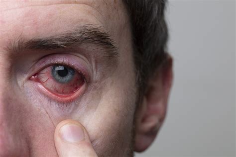 10 Commonly Asked Questions About Uveitis Ke Eye Centers Of Texas