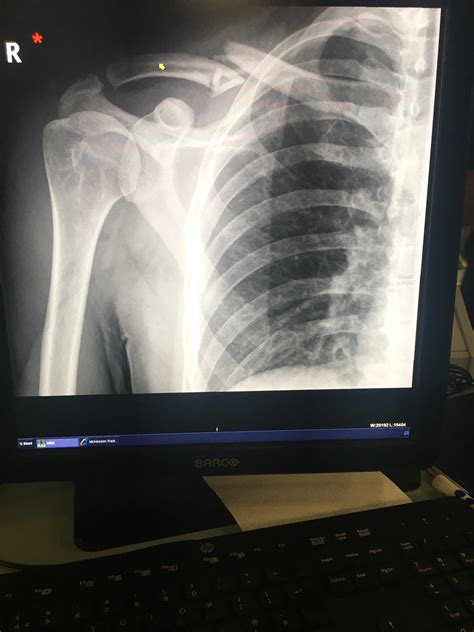 My Broken collarbone - Any tips for helping this heal? The doctors at