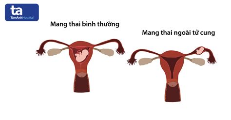 Rất Hay Hiện tượng thai ngoài tử cung như thế nào