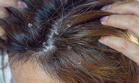 Como Tratar Seborreia Na Cabeça - O que é e como tratar a dermatite seborreica no couro cabeludo