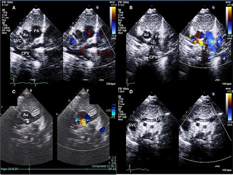 Svc And Innominate Vein Anatomy