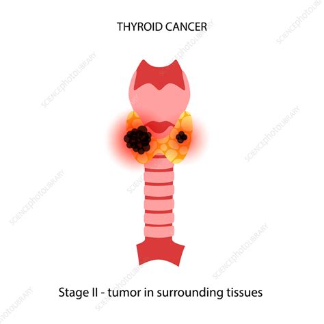 Thyroid Cancer Illustration Stock Image F Science Photo