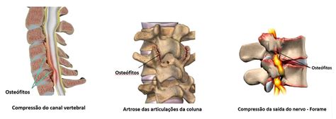 Osteófitos Da Coluna Vertebral Dr Ricardo Teixeira