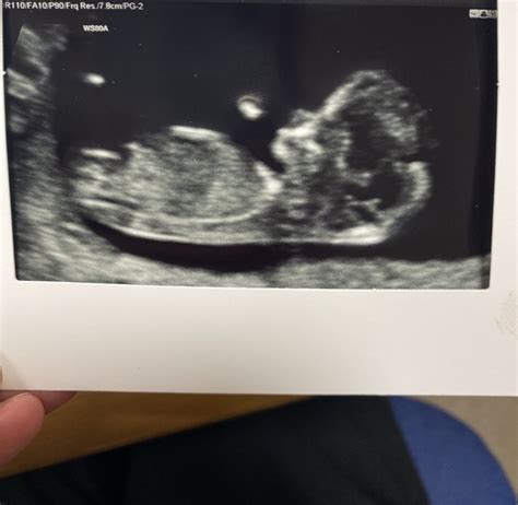 Nub Theory 12 Week Scan Hit Me With Your Guesses Mumsnet