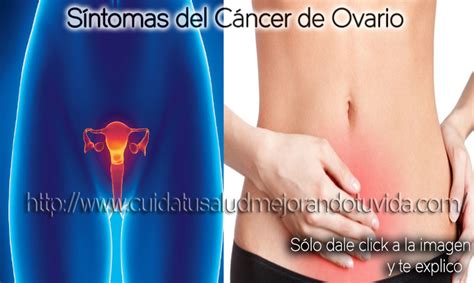 Síntomas Del Cáncer De Ovario