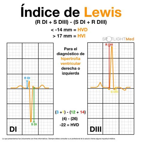 Índices de EKG para valorar hipertrofia ventricular SpotlightMed