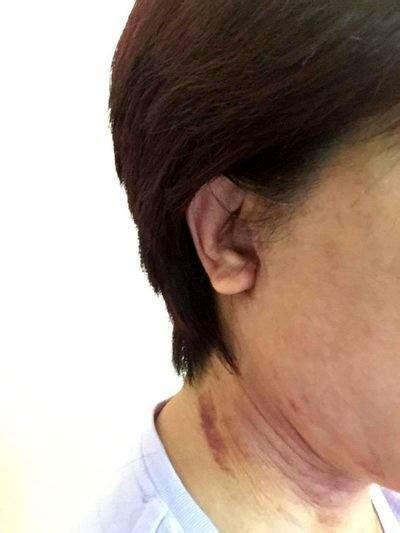 Lower Face And Neck Lift Scars Photos (1) » Facelift: Info, Prices ...