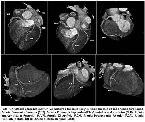 TC multidetector de las variantes anatómicas en las arterias coronarias