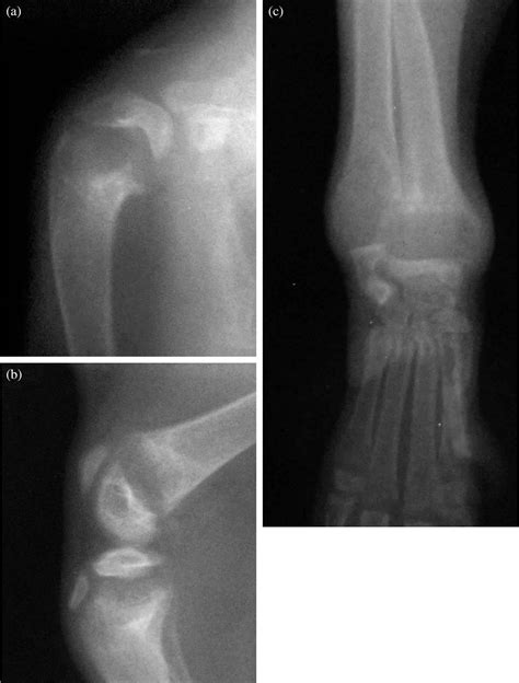 Vitamin D Dependent Rickets Type 2 With Characteristic Radiographic