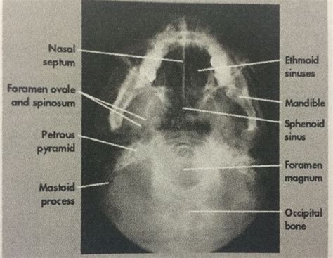 SMV basilar for Skull | Radiology technician, Anatomy and physiology ...