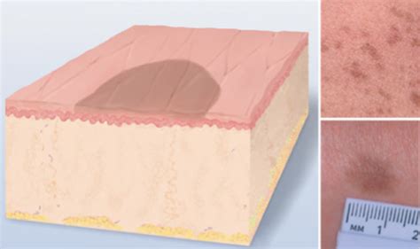 Skin Lesions Flashcards Quizlet