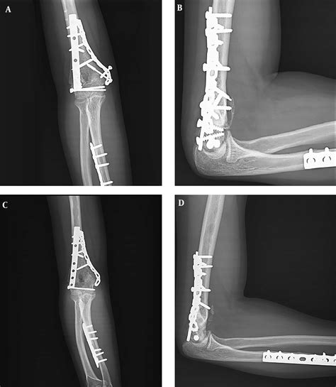 A Anteroposterior And B Lateral Pre Operative Radiographs Of A