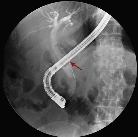 Ercp Stone