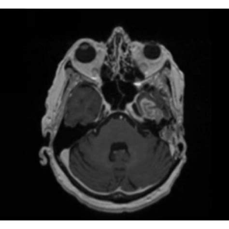 Axial Slices Of T1 Postcontrast A And T2 FLAIR B MRIs Are Shown