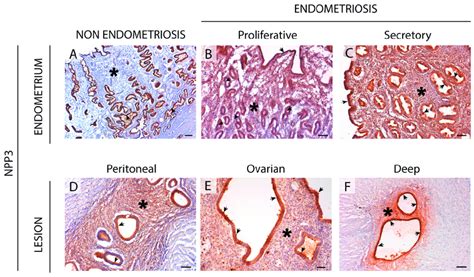 Immunolocalization Of Npp3 In The Eutopic A C And Ectopic D F Download Scientific Diagram