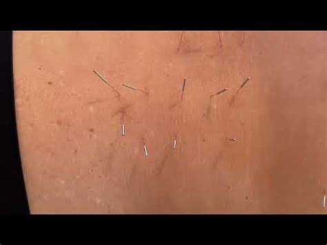 Dry Needling The Motor Point Of The Quadratus Lumborum Gluteus Minimus