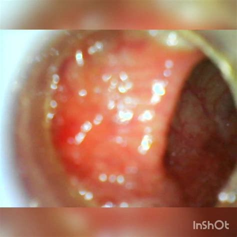 Usb Endoscope Cm Deep Anal Insertion Porn D Xhamster Xhamster