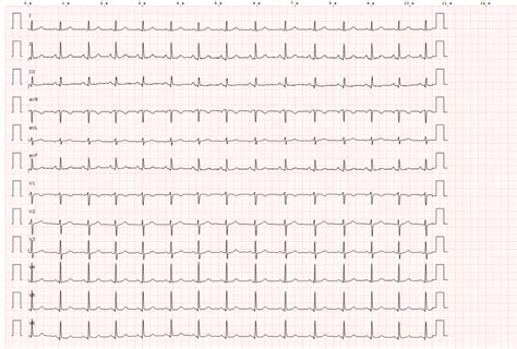 Electrocardiograma Ecg Normal Valores Y Ondas Normales